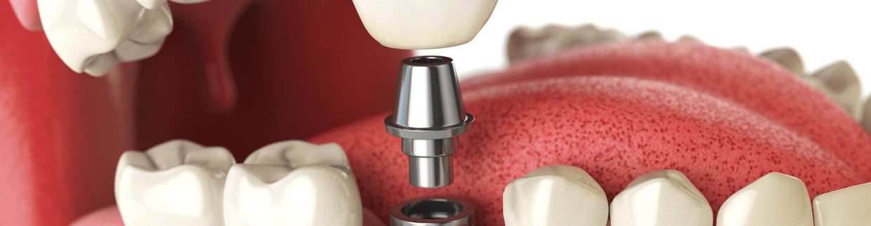 Dental Implants in Johor Bahru | TAG Dental