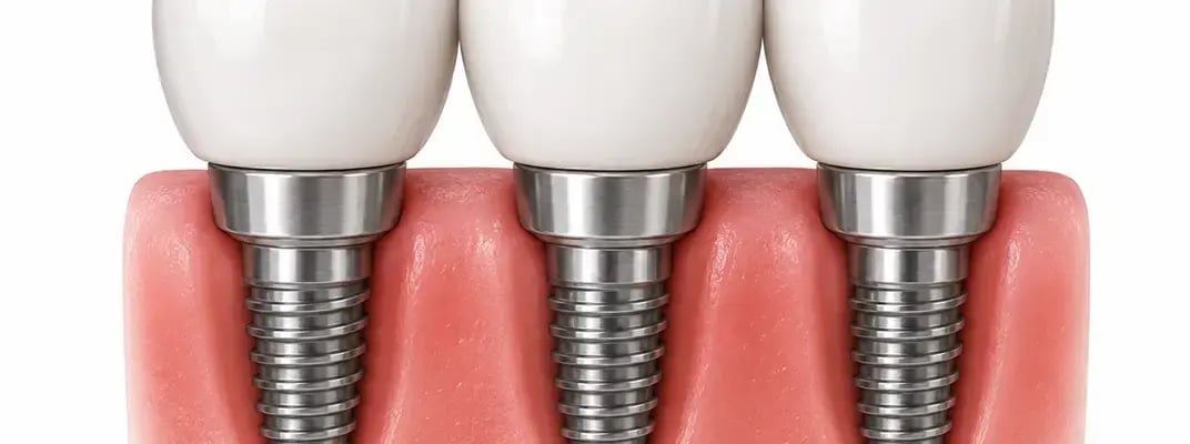 Dental_implants_tagdental_media