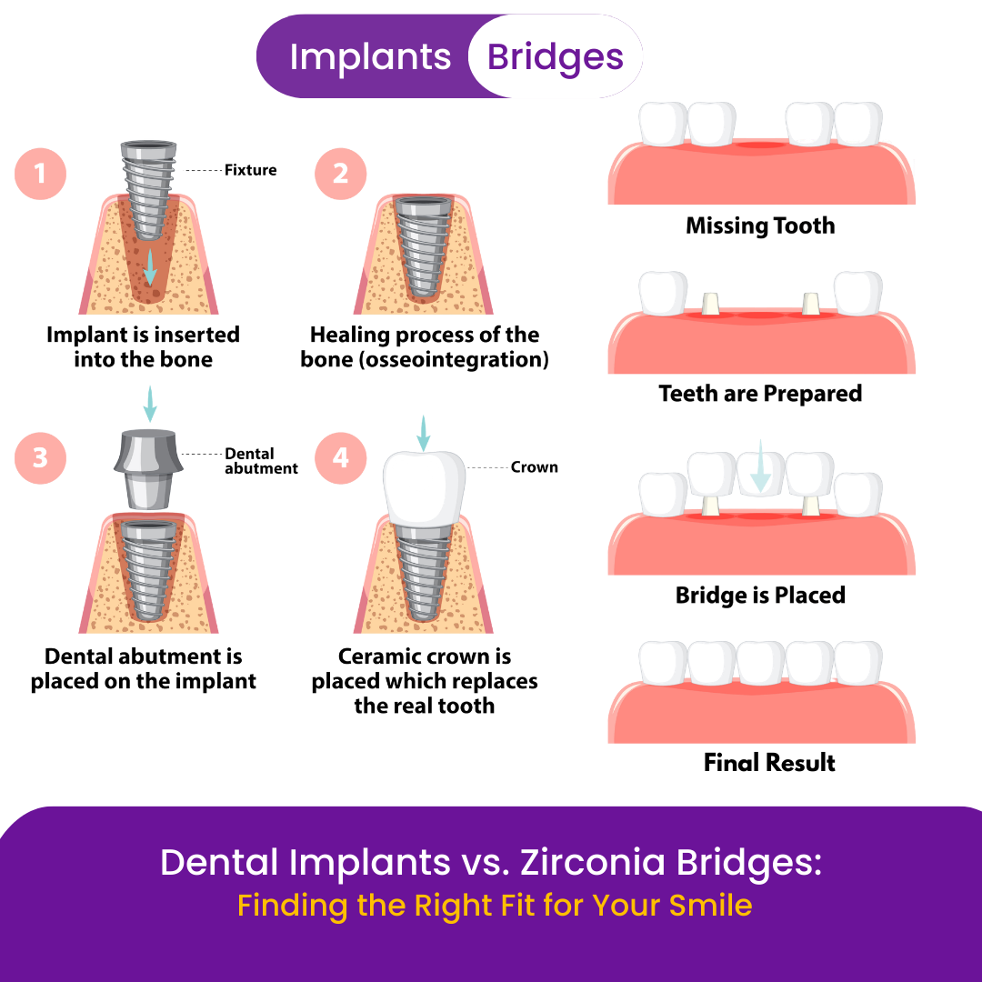 What is the difference between a dental implant and a zirconia bridge?