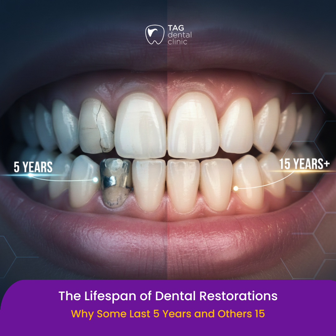 The Lifespan of Dental Restorations