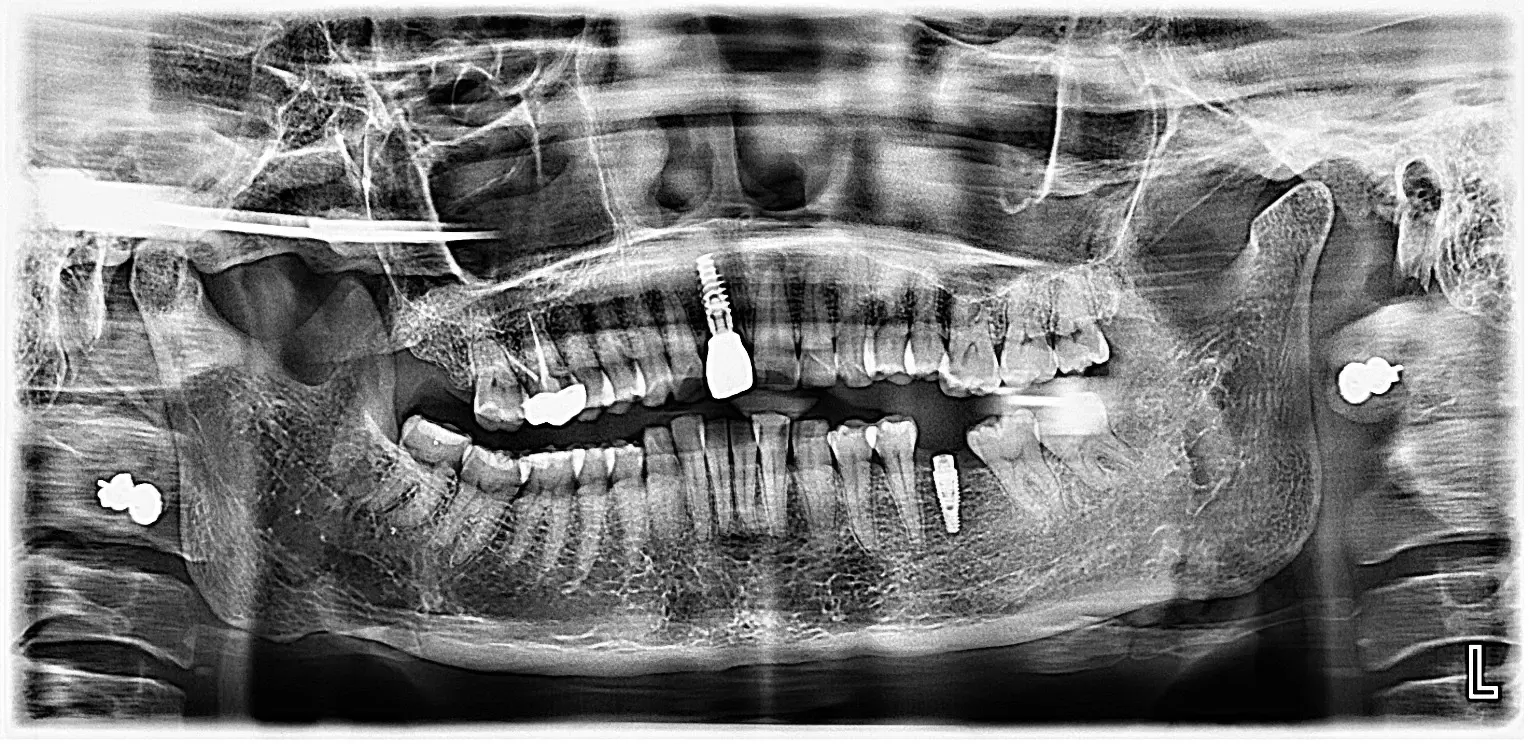 OPG-After-Implant