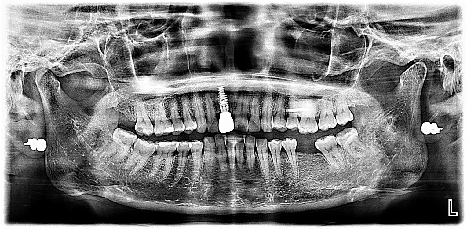 OPG-Before-Implant