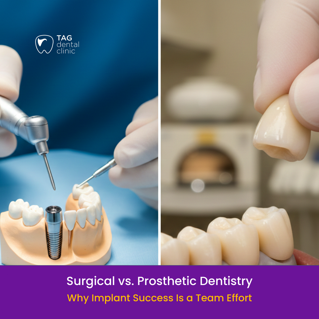 Surgical vs. Prosthetic Dentistry: Why Implant Success Is a Team Effort