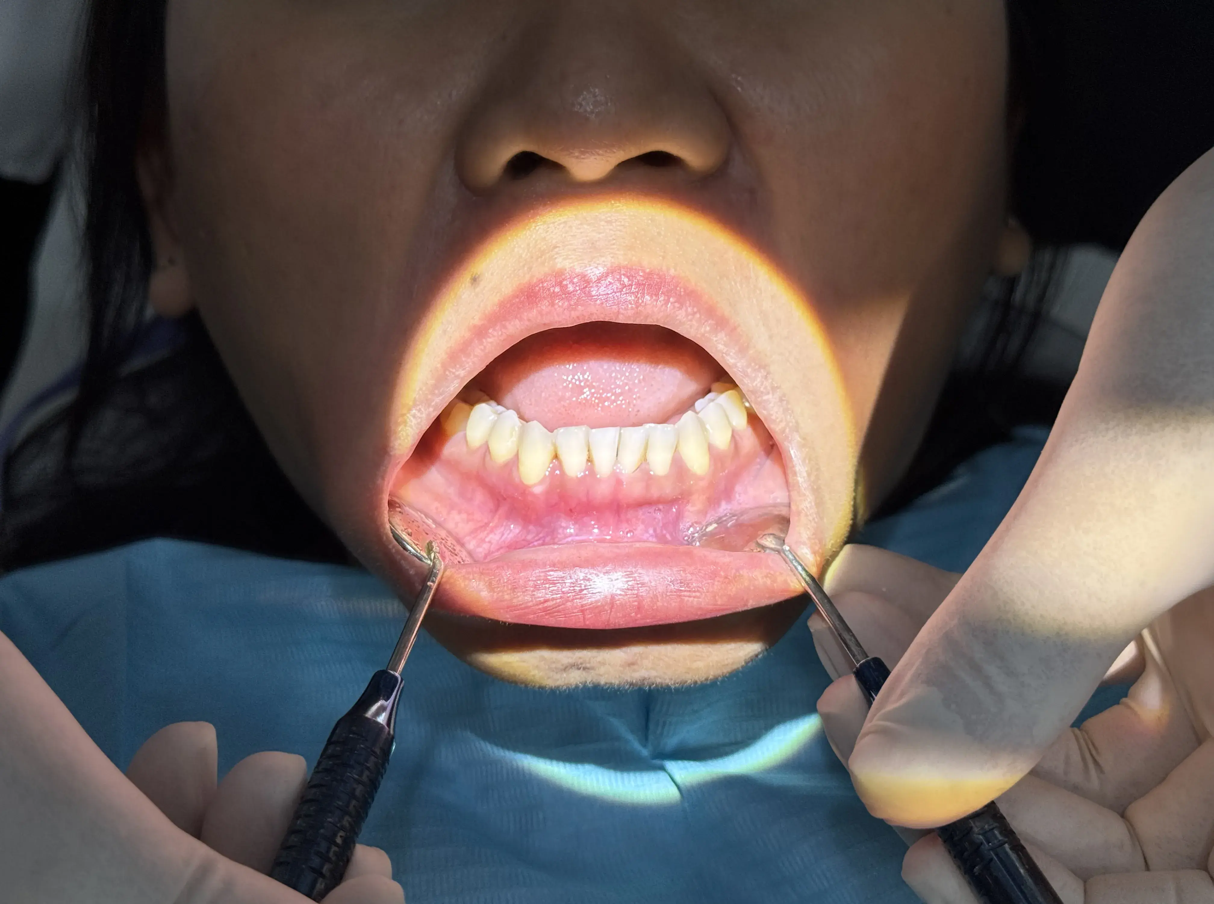 after-suture-removal