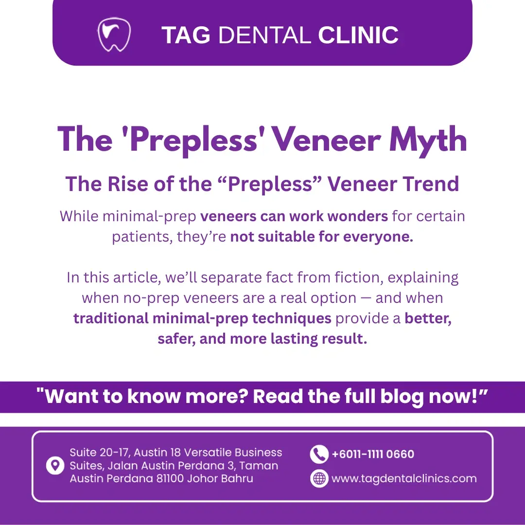 The 'Prepless' Veneer Myth: When Minimal or No-Prep Veneers Are Truly Possible