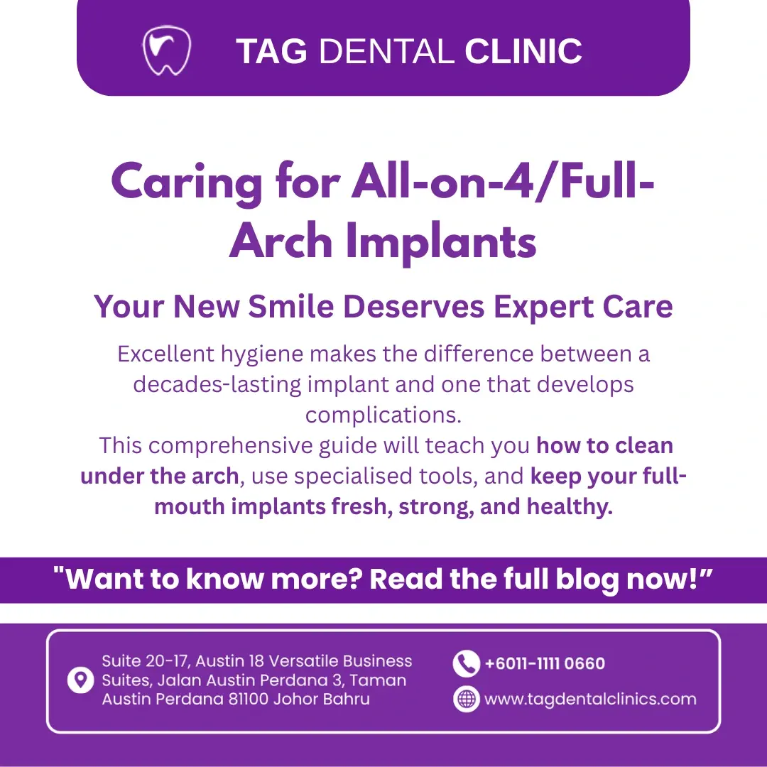 Caring for All-on-4/Full-Arch Implants: A Comprehensive Guide to Long-Term Hygiene