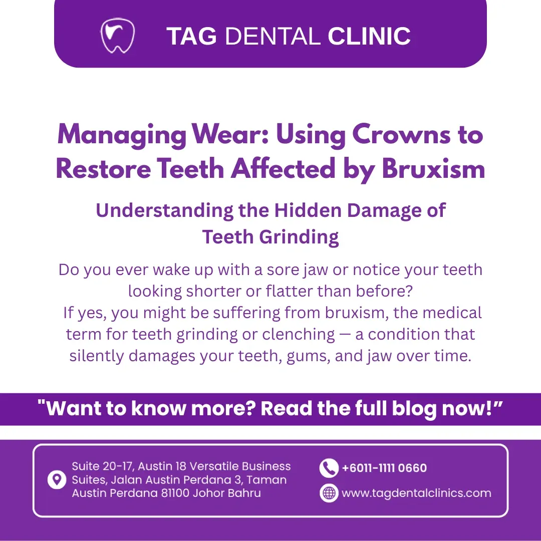 Managing Wear: Using Crowns to Restore Teeth Affected by Bruxism