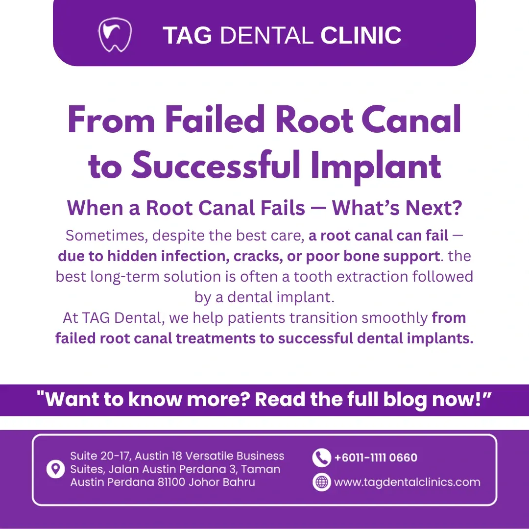 From Failed Root Canal to Successful Implant: The Extraction-to-Implant Timeline