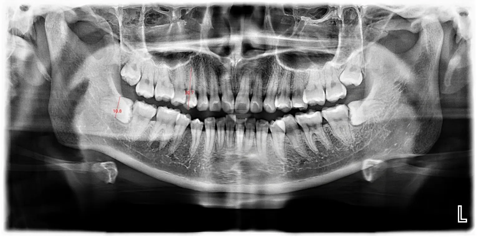 opg-xray-impacted-wisdom-tooth