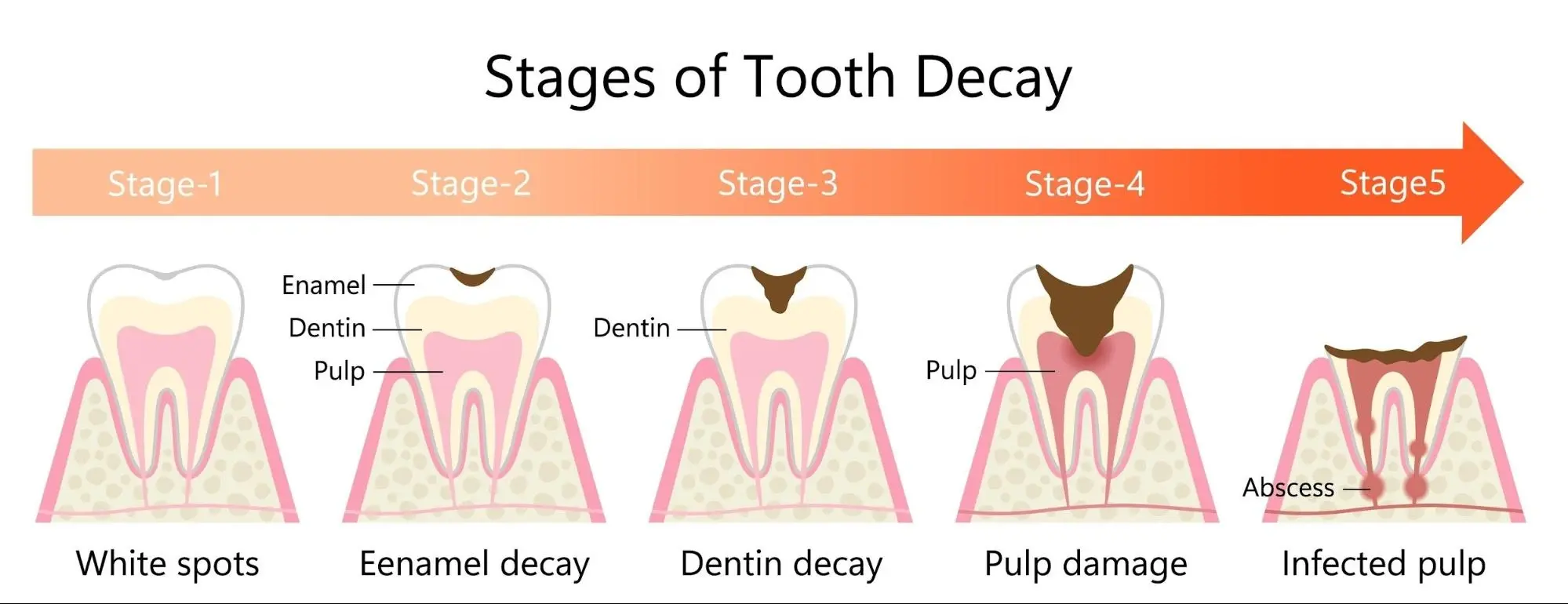 stages of tooth decay