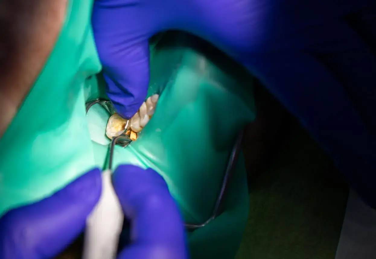 Root canal treatment removes infected pulp while preserving the natural tooth.