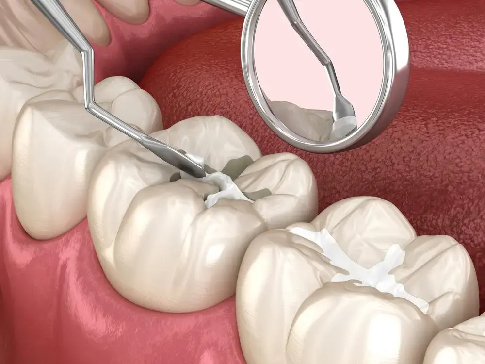 Composite filling used to repair a cavity before it reaches the tooth nerve.