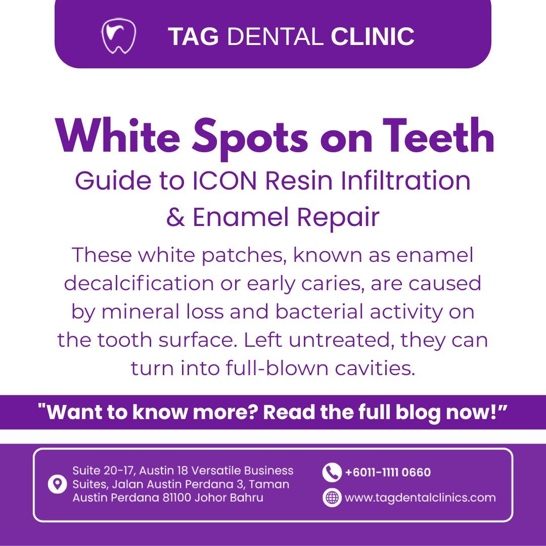 White Spots on Teeth? JB’s Guide to ICON Resin Infiltration & Enamel Repair